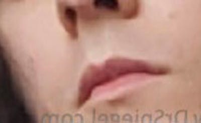 Lip Lift Before & After Gallery - Patient 214308 - Image 1