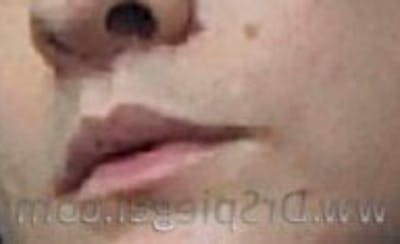 Lip Lift Before & After Gallery - Patient 214308 - Image 2