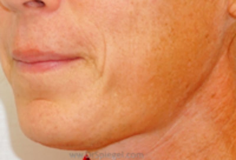 Lip Lift Before & After Gallery - Patient 782283 - Image 1