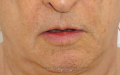 Lip Lift Before & After Gallery - Patient 234980 - Image 1