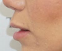 Lip Lift Before & After Gallery - Patient 256782 - Image 1