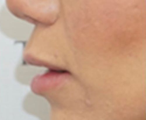 Lip Lift Before & After Gallery - Patient 256782 - Image 1