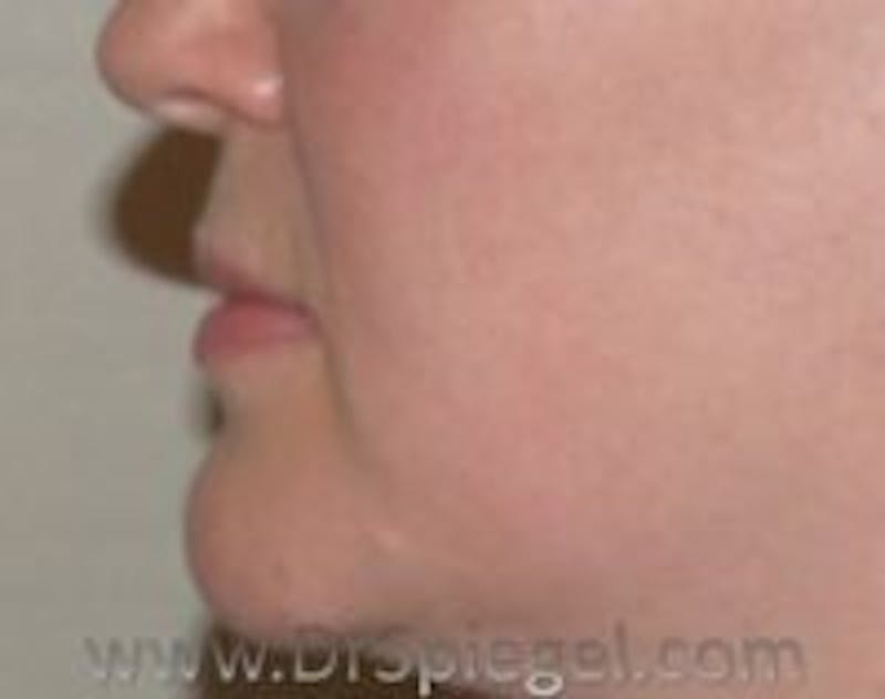 Lip Lift Before & After Gallery - Patient 201468 - Image 1