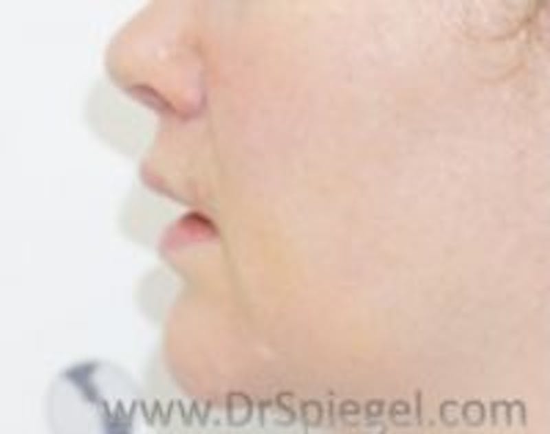 Lip Lift Before & After Gallery - Patient 201468 - Image 2