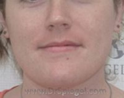FFS Mandible Contouring Before & After Gallery - Patient 353255 - Image 1