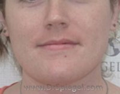 Lip Lift Before & After Gallery - Patient 408773 - Image 1