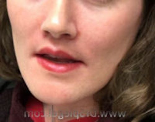 Lip Lift Before & After Gallery - Patient 408773 - Image 2