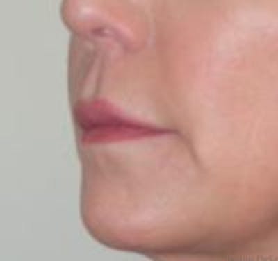 Lip Lift Before & After Gallery - Patient 361972 - Image 1