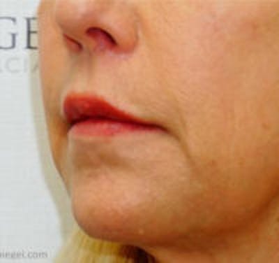 Lip Lift Before & After Gallery - Patient 361972 - Image 2