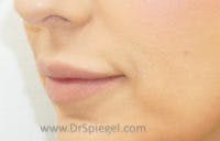 Lip Lift Before & After Gallery - Patient 406762 - Image 1