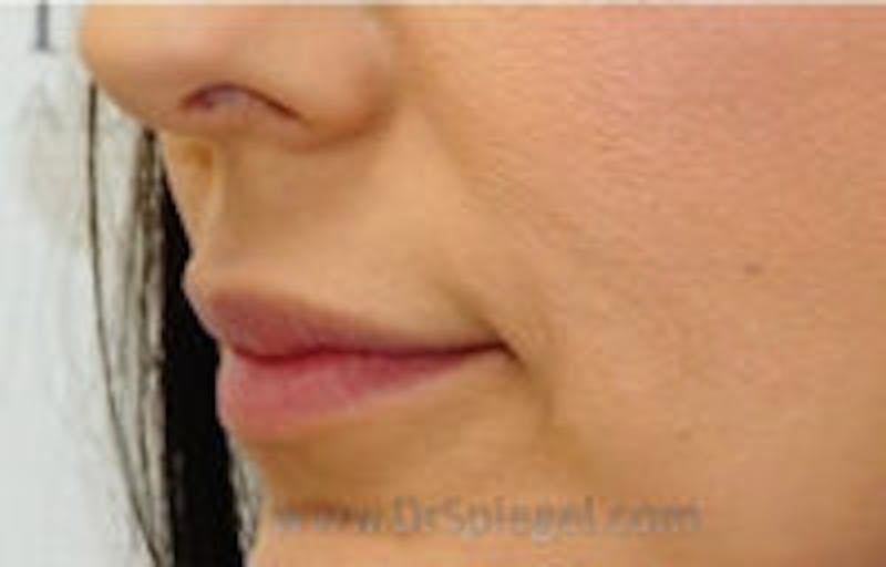 Lip Lift Before & After Gallery - Patient 406762 - Image 2