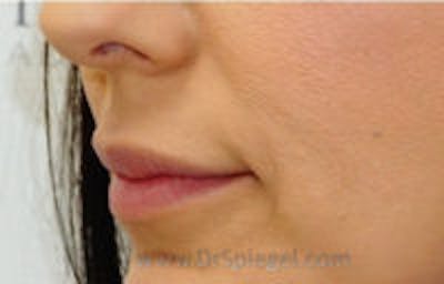 Lip Lift Before & After Gallery - Patient 406762 - Image 2