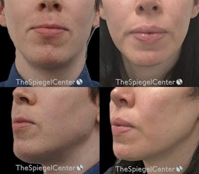 Mandible Contouring Before & After Gallery - Patient 213117 - Image 1
