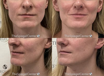 Mandible Contouring Before & After Gallery - Patient 377389 - Image 1