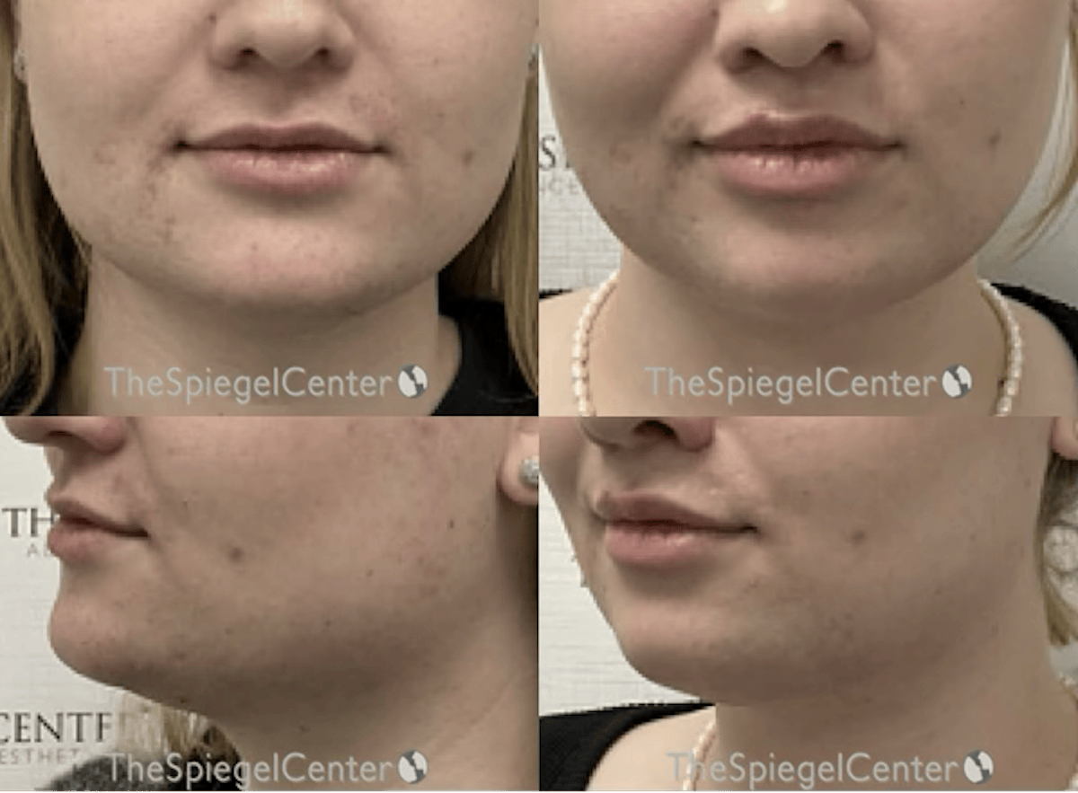 Mandible Contouring Before & After Gallery - Patient 320233 - Image 1