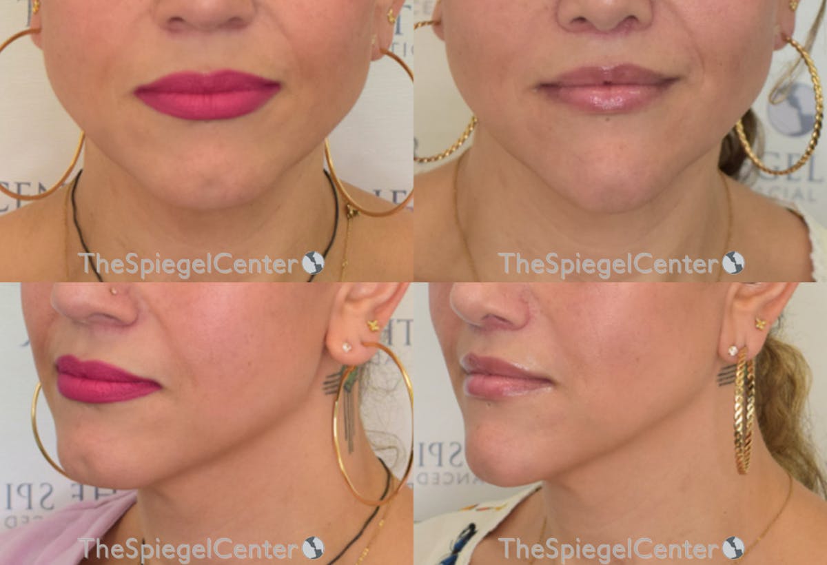Mandible Contouring Before & After Gallery - Patient 748600 - Image 1