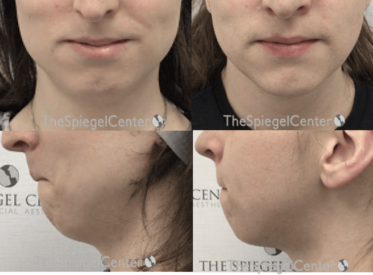 Mandible Contouring Before & After Gallery - Patient 559504 - Image 1
