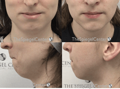 Mandible Contouring Before & After Gallery - Patient 559504 - Image 1