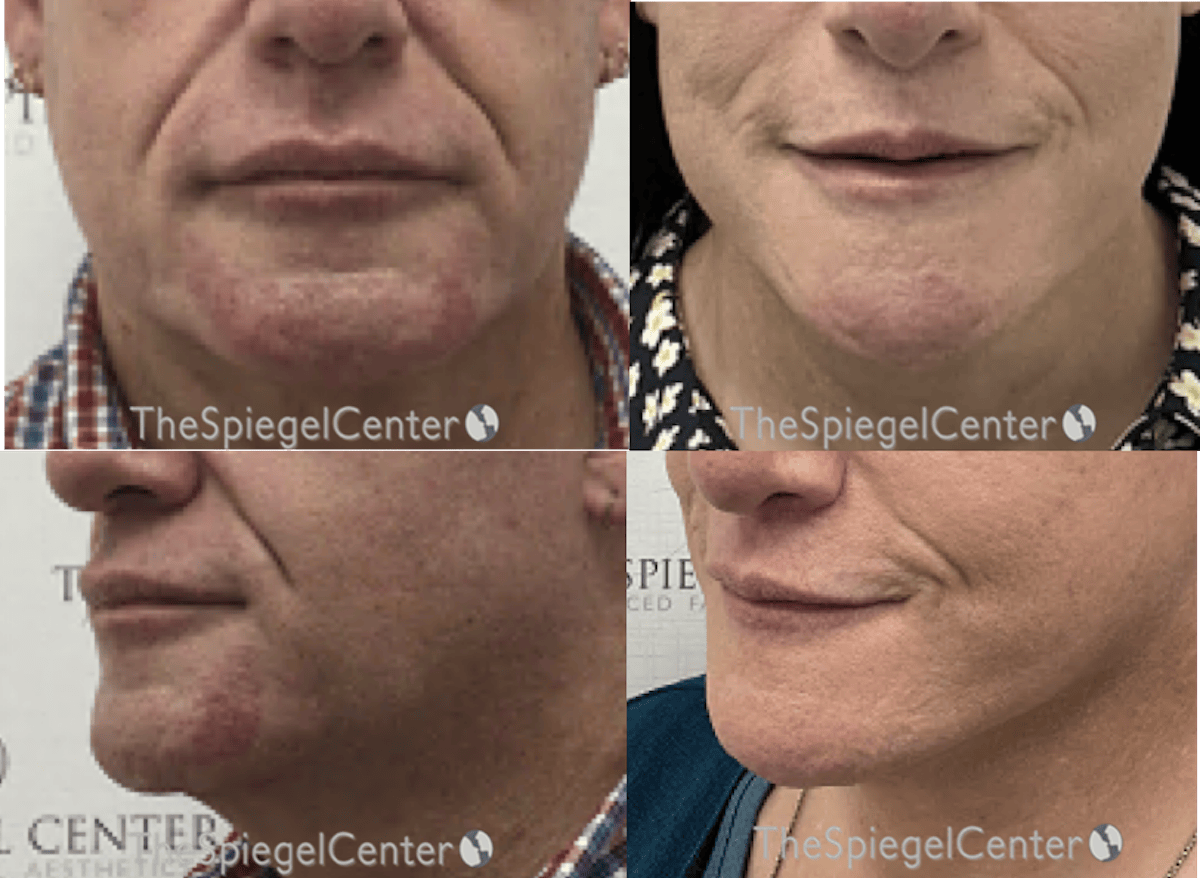 Mandible Contouring Before & After Gallery - Patient 368861 - Image 1