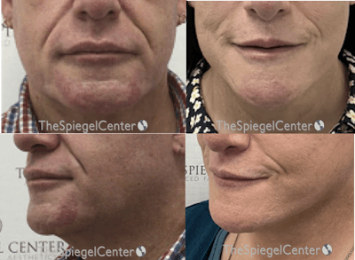 Mandible Contouring Before & After Gallery - Patient 368861 - Image 1