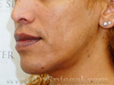 Mandible Contouring Before & After Gallery - Patient 351812 - Image 3