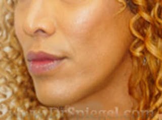 Mandible Contouring Before & After Gallery - Patient 351812 - Image 4