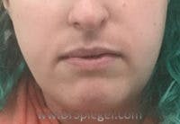 Mandible Contouring Before & After Gallery - Patient 261438 - Image 1