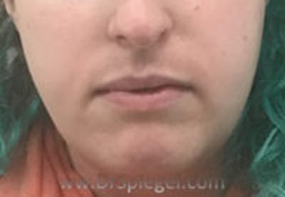 Mandible Contouring Before & After Gallery - Patient 261438 - Image 1