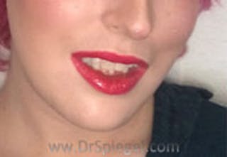 Mandible Contouring Before & After Gallery - Patient 261438 - Image 2