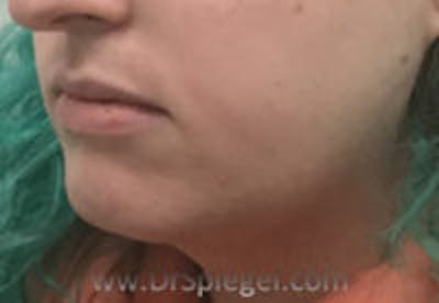 Mandible Contouring Before & After Gallery - Patient 261438 - Image 3