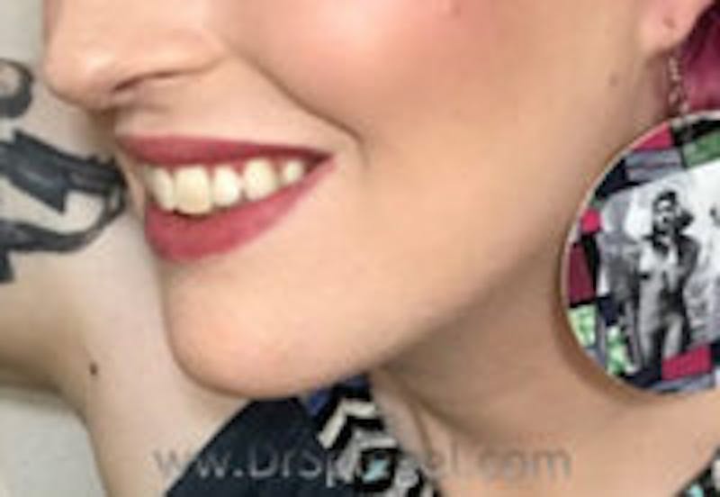 Mandible Contouring Before & After Gallery - Patient 261438 - Image 4