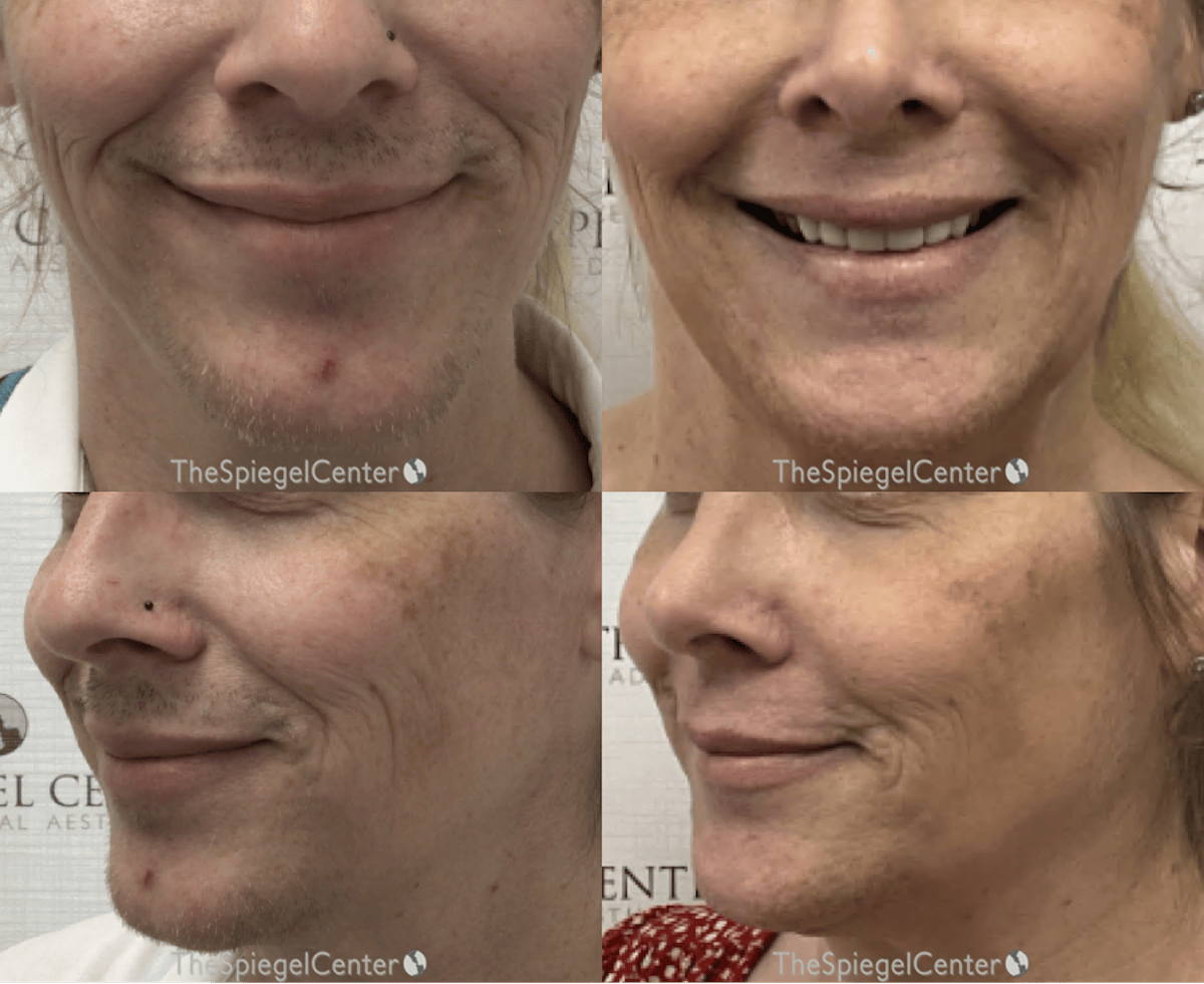 Mandible Contouring Before & After Gallery - Patient 252463 - Image 1