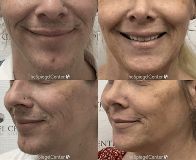 Mandible Contouring Before & After Gallery - Patient 252463 - Image 1