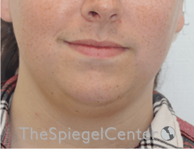 Mandible Contouring Before & After Gallery - Patient 638997 - Image 1