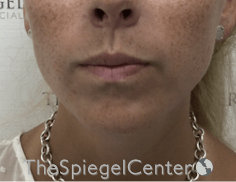 Mandible Contouring Before & After Gallery - Patient 638997 - Image 2