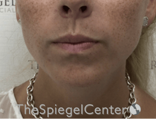 Mandible Contouring Before & After Gallery - Patient 638997 - Image 2