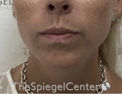 Mandible Contouring Before & After Gallery - Patient 638997 - Image 2
