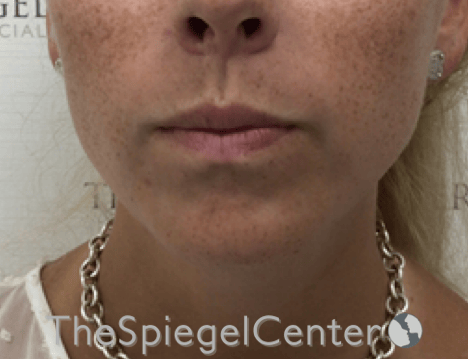 Mandible Contouring Before & After Gallery - Patient 638997 - Image 2