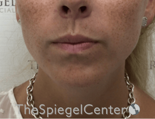 Mandible Contouring Before & After Gallery - Patient 638997 - Image 2