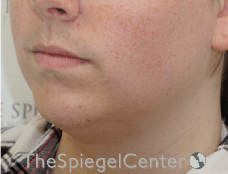Mandible Contouring Before & After Gallery - Patient 638997 - Image 3