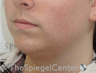Mandible Contouring Before & After Gallery - Patient 638997 - Image 3