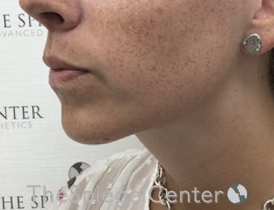 Mandible Contouring Before & After Gallery - Patient 638997 - Image 4