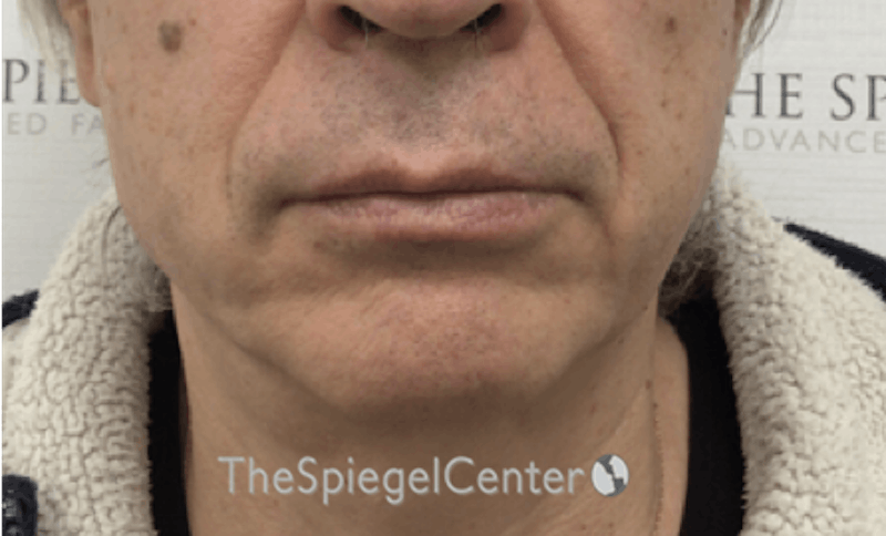 Mandible Contouring Before & After Gallery - Patient 151938 - Image 1