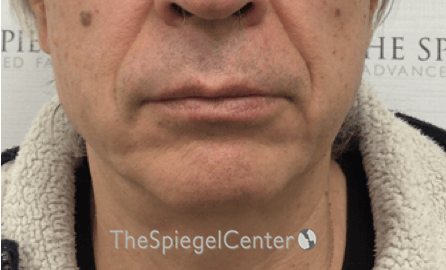 Mandible Contouring Before & After Gallery - Patient 151938 - Image 1