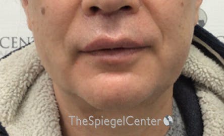 Mandible Contouring Before & After Gallery - Patient 151938 - Image 2
