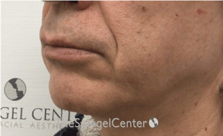 Mandible Contouring Before & After Gallery - Patient 151938 - Image 3