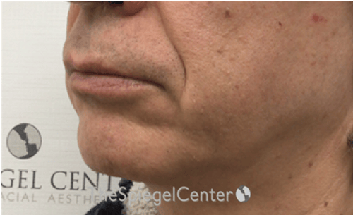 Mandible Contouring Before & After Gallery - Patient 151938 - Image 3