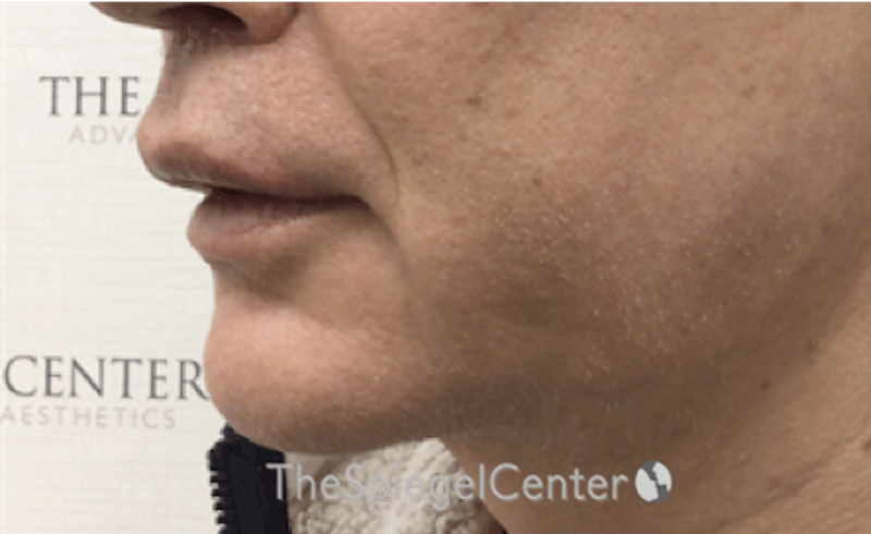 Mandible Contouring Before & After Gallery - Patient 151938 - Image 4