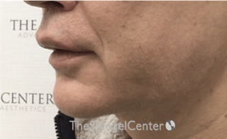 Mandible Contouring Before & After Gallery - Patient 151938 - Image 4