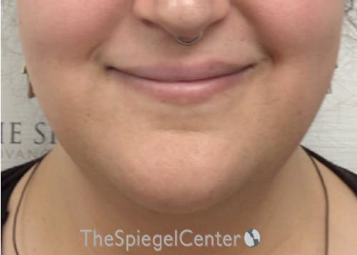 Mandible Contouring Before & After Gallery - Patient 194300 - Image 1